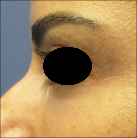 Eye-Rejuvenation